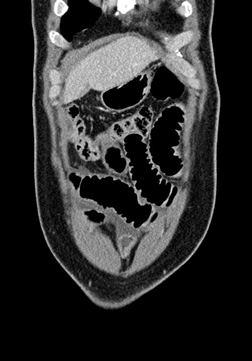 Adhesional small bowel obstruction (Radiopaedia 58900-66131 Coronal C+ portal venous phase 73).jpg
