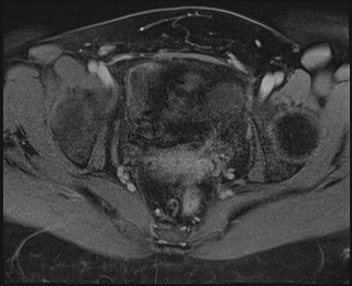 File:Adnexal multilocular cyst (O-RADS US 3. O-RADS MRI 3) (Radiopaedia 87426-103754 Axial 232).jpeg
