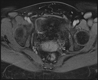 File:Adnexal multilocular cyst (O-RADS US 3. O-RADS MRI 3) (Radiopaedia 87426-103754 Axial 234).jpeg