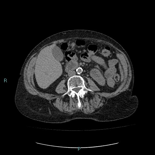 File:Adrenal collision tumor (ACT) (Radiopaedia 48462-53379 Axial non-contrast 31).jpg