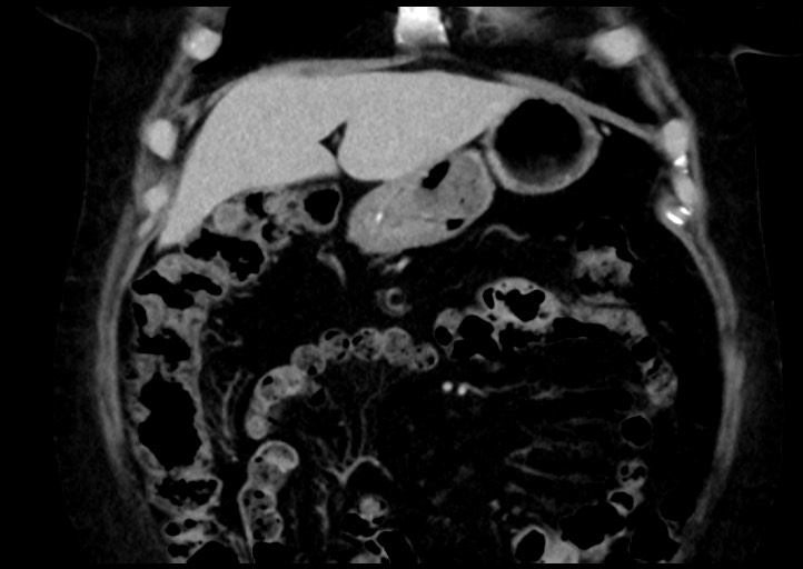 Adrenal cortical carcinoma (Radiopaedia 64017-72769 Coronal C+ portal venous phase 13).jpg