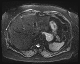 Adrenal cortical carcinoma (Radiopaedia 64017-72770 Axial DWI 5).jpg