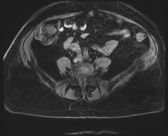 File:Adrenal cortical carcinoma (Radiopaedia 64017-72770 Axial T1 C+ fat sat 58).jpg