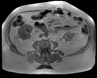 File:Adrenal cortical carcinoma (Radiopaedia 64017-72770 Axial T1 in-phase 55).jpg