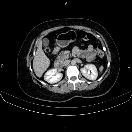 Adrenal cortical carcinoma (Radiopaedia 84882-100379 Axial C+ delayed 32).jpg
