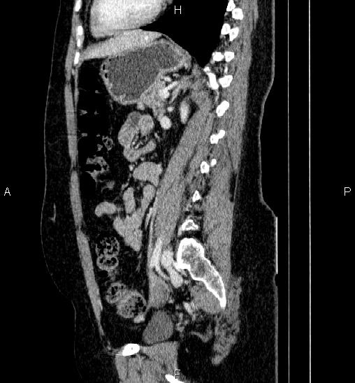 Adrenal cortical carcinoma (Radiopaedia 84882-100379 Sagittal C+ portal venous phase 56).jpg