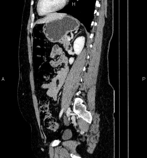 Adrenal cortical carcinoma (Radiopaedia 84882-100379 Sagittal C+ portal venous phase 58).jpg