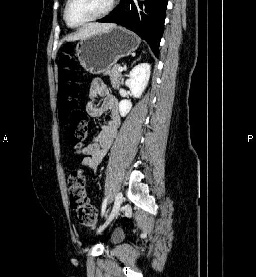Adrenal cortical carcinoma (Radiopaedia 84882-100379 Sagittal C+ portal venous phase 59).jpg