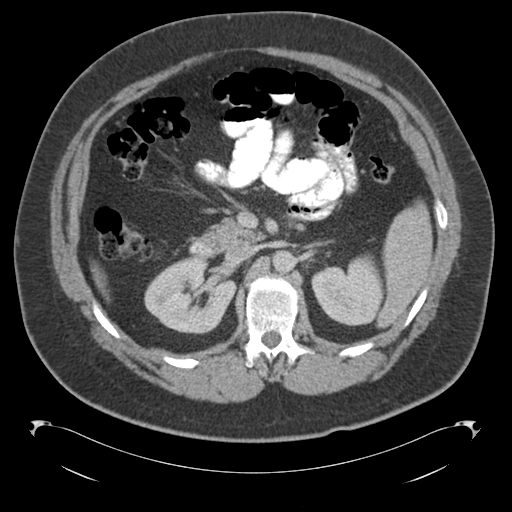 Adrenal cyst (Radiopaedia 45625-49776 Axial C+ portal venous phase 37).png