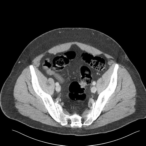 Adrenal cyst (Radiopaedia 45625-49777 Axial C+ portal venous phase 83).png
