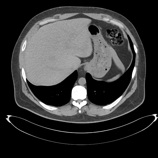 Adrenal cyst (Radiopaedia 45625-49778 Axial non-contrast 12).png