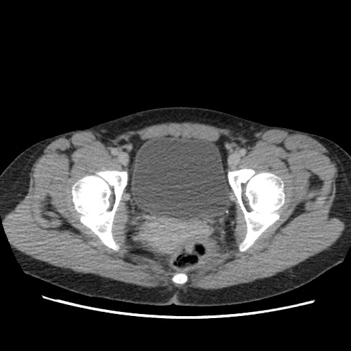 File:Adrenal cyst (Radiopaedia 64869-73813 Axial C+ portal venous phase 75).jpg