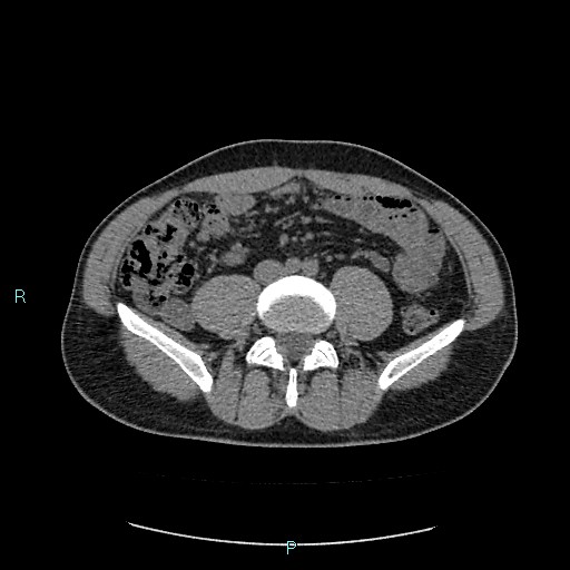 File:Adrenal cystic lymphangioma (Radiopaedia 83161-97534 Axial non-contrast 60).jpg