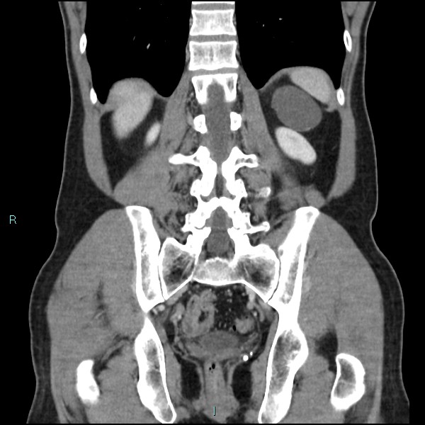 Adrenal cystic lymphangioma (Radiopaedia 83161-97534 Coronal C+ portal venous phase 56).jpg