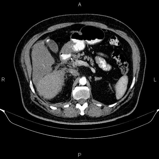 Adrenal hemorrhage (Radiopaedia 62622-70916 Axial C+ arterial phase 130).jpg