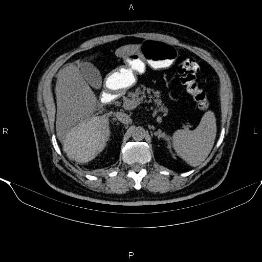 Adrenal hemorrhage (Radiopaedia 62622-70916 Axial non-contrast 61).jpg