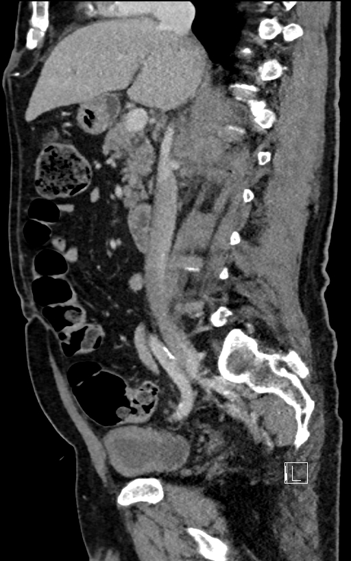 Adrenal lymphoma (Radiopaedia 73730-84529 Sagittal C+ portal venous phase 50).jpg