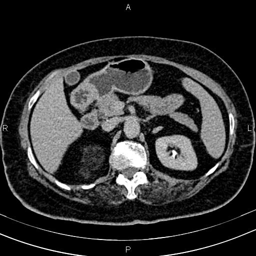 Adrenal myelolipoma (Radiopaedia 82742-96986 Axial renal excretory phase 48).jpg