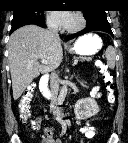 Adrenal myelolipoma (Radiopaedia 84319-99617 Coronal renal cortical phase 38).jpg