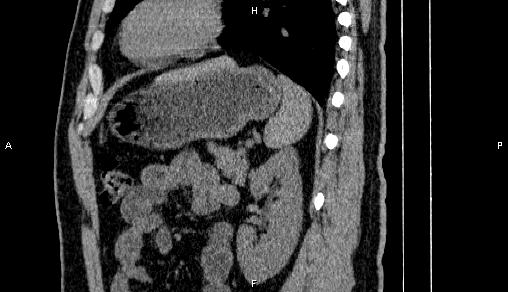 File:Adrenal myelolipoma (Radiopaedia 84321-99619 Sagittal non-contrast 77).jpg