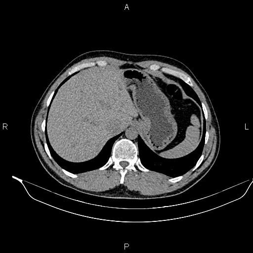 Adrenal myelolipoma (Radiopaedia 87794-104246 Axial non-contrast 20).jpg