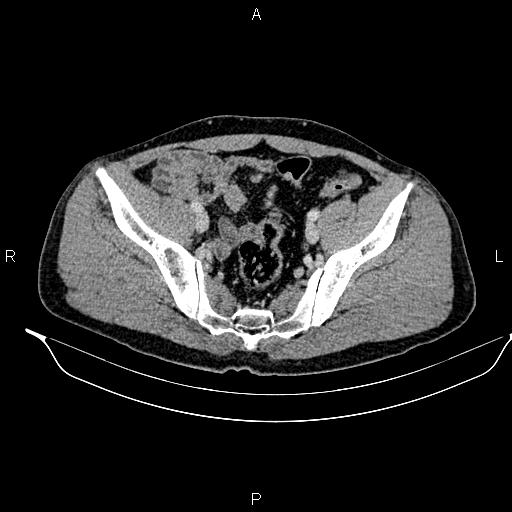Adrenal myelolipoma (Radiopaedia 87794-104246 Axial renal cortical phase 88).jpg