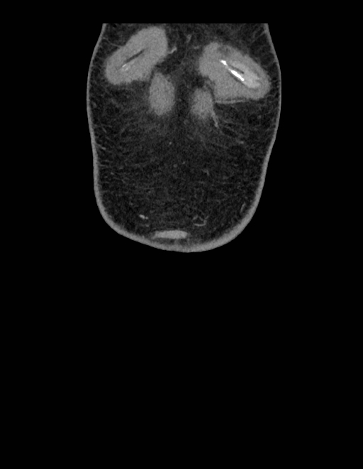 Adrenal myelolipoma - bilateral (Radiopaedia 74805-85810 Coronal C+ portal venous phase 258).jpg