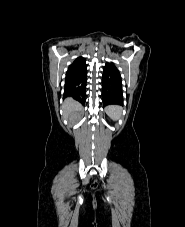 Adrenocortical carcinoma (Radiopaedia 80134-93438 Coronal C+ portal venous phase 138).jpg