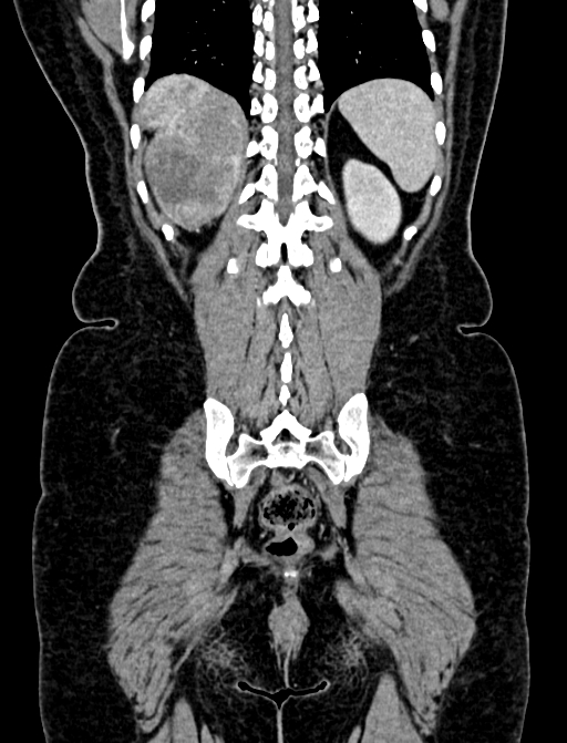 Adrenocortical carcinoma (Radiopaedia 87281-103569 Coronal C+ portal venous phase 121).jpg