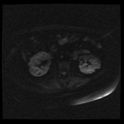 Adult polycystic kidney disease (Radiopaedia 59075-66365 Axial DWI 43).jpg