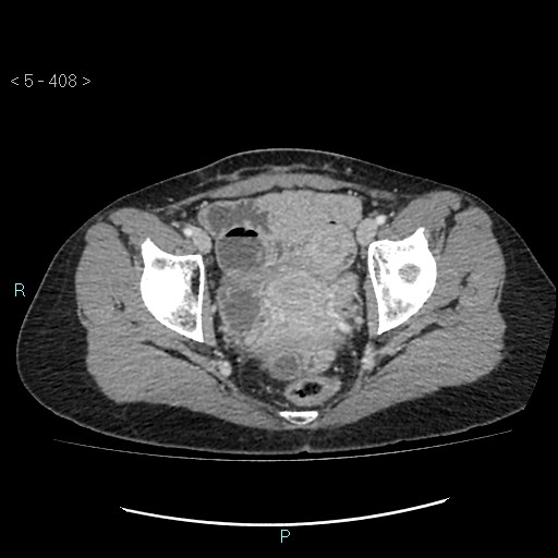 Adult transient intestinal intussusception (Radiopaedia 34853-36310 Axial C+ portal venous phase 107).jpg