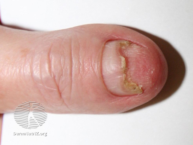File:After use of clobetasol for 2 months (DermNet NZ scaly-acropustulosis-02).jpg