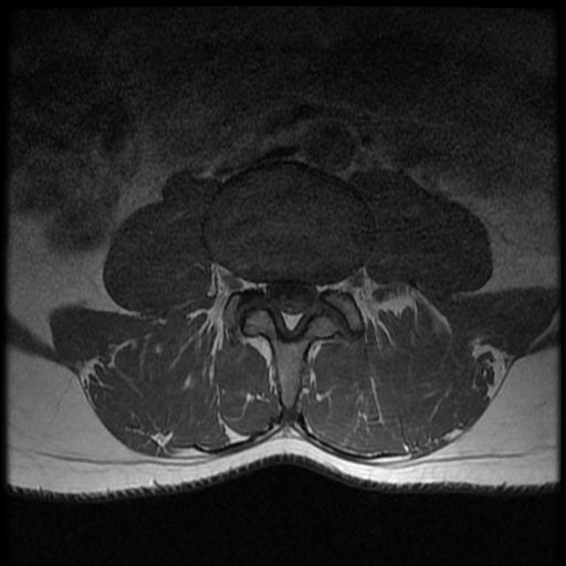 File:Aggressive vertebral hemangioma with pathological fracture (Radiopaedia 69528-79411 Axial T1 C+ 5).jpg