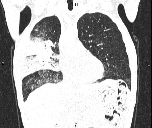 Air bronchogram in pneumonia (Radiopaedia 85719-101512 Coronal lung window 22).jpg
