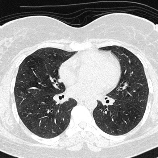 File:Air trapping in small airway disease (Radiopaedia 61685-69694 Axial lung window 86).jpg