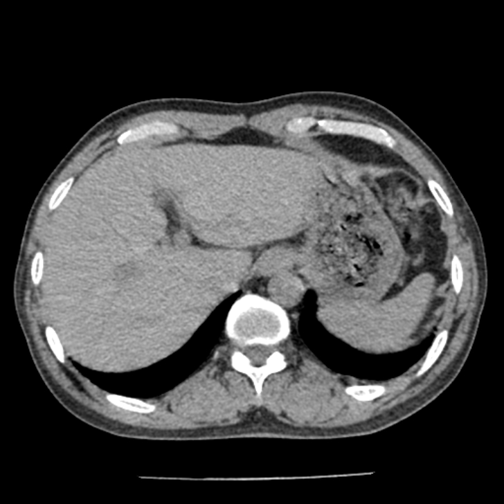 Airway foreign body in adult (Radiopaedia 85907-101779 Axial liver window 187).jpg