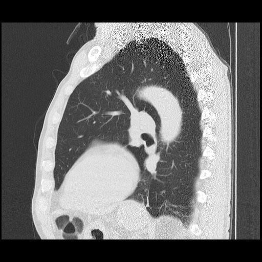 Allergic bronchopulmonary aspergillosis (ABPA) (Radiopaedia 60594-68313 Sagittal lung window 22).jpg