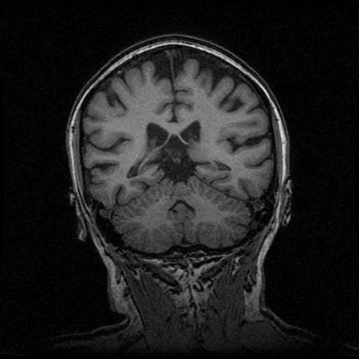 Alzheimer's disease (Radiopaedia 30244-30872 Coronal T1 49).jpg