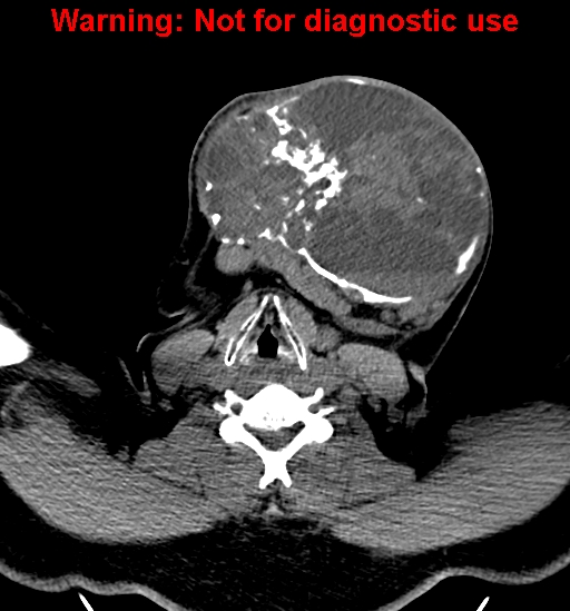File:Ameloblastoma (Radiopaedia 33126-34164 A 23).jpg