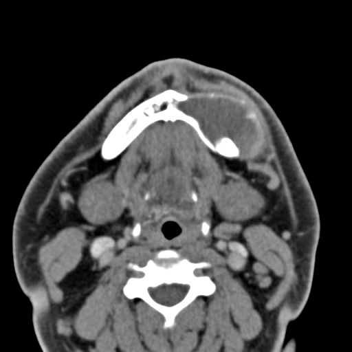 File:Ameloblastoma (Radiopaedia 33677-34806 Axial non-contrast 29).png