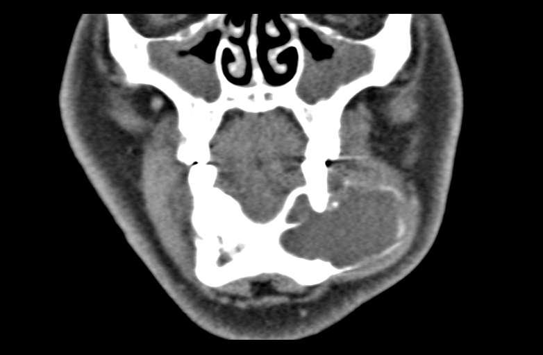 Ameloblastoma (Radiopaedia 33677-34806 Coronal non-contrast 19).png