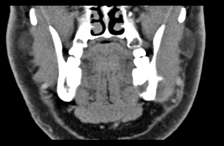 File:Ameloblastoma (Radiopaedia 33677-34806 Coronal non-contrast 28).png