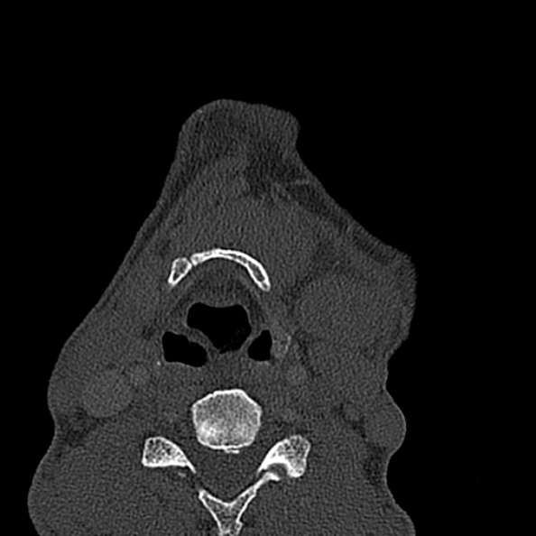 Ameloblastoma (Radiopaedia 51921-57766 Axial bone window 12).jpg
