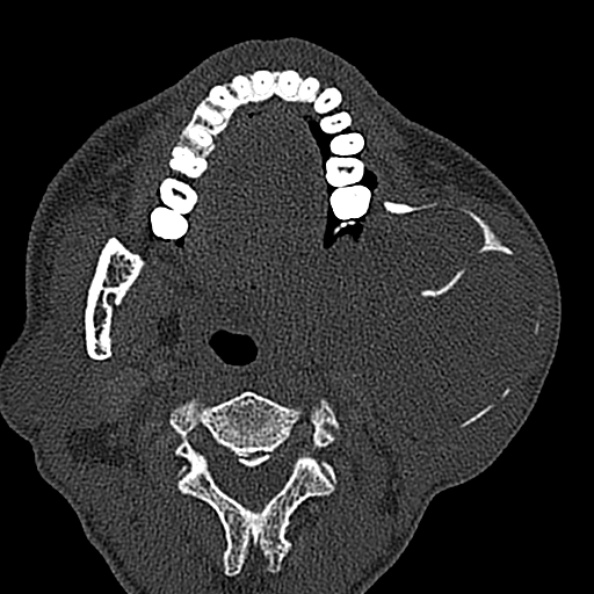 Ameloblastoma (Radiopaedia 51921-57766 Axial bone window 86).jpg