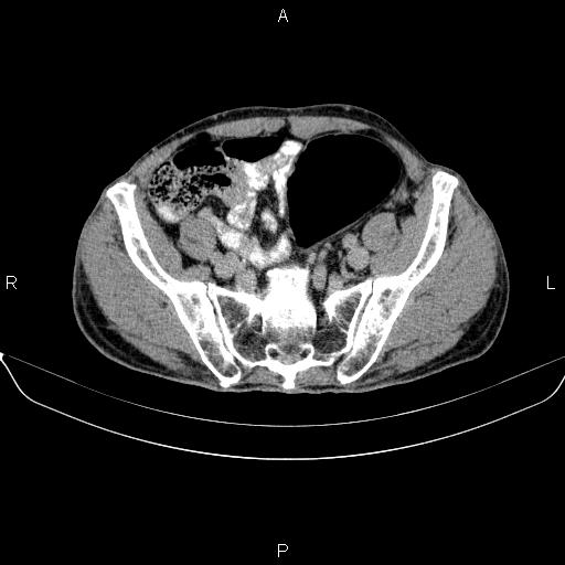Ampullary adenocarcinoma (Radiopaedia 86093-102032 Axial C+ delayed 83).jpg