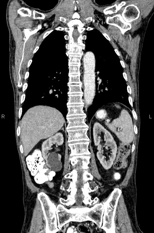 Ampullary adenocarcinoma (Radiopaedia 86093-102033 D 43).jpg