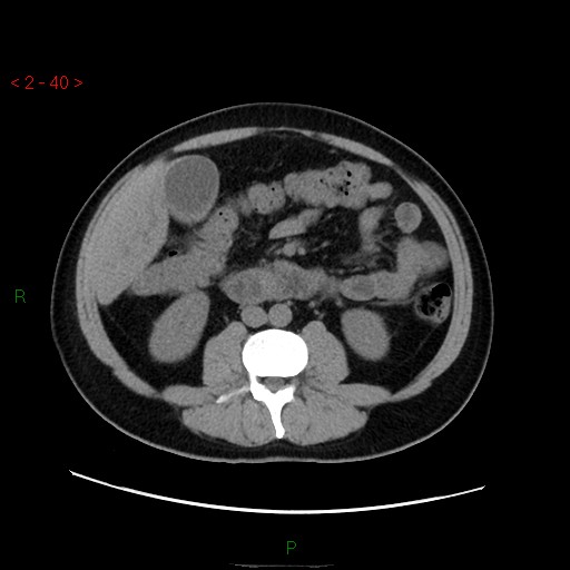 File:Ampullary carcinoma (Radiopaedia 56396-63056 Axial non-contrast 27).jpg