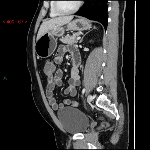 Ampullary carcinoma (Radiopaedia 56396-63056 D 66).jpg