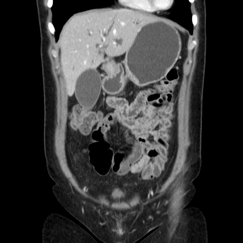 Ampullary tumor (Radiopaedia 22787-22816 E 16).jpg