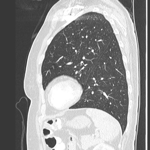 Amyloidosis - bronchial and diffuse nodular pulmonary involvement (Radiopaedia 60156-67745 Sagittal lung window 68).jpg
